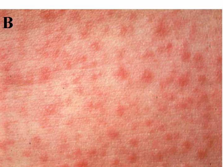 allergic reaction rash. Allergic Reactions Rash